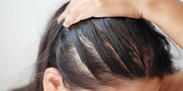What Causes Alopecia? Early Signs, Treatments, And Prevention Tips