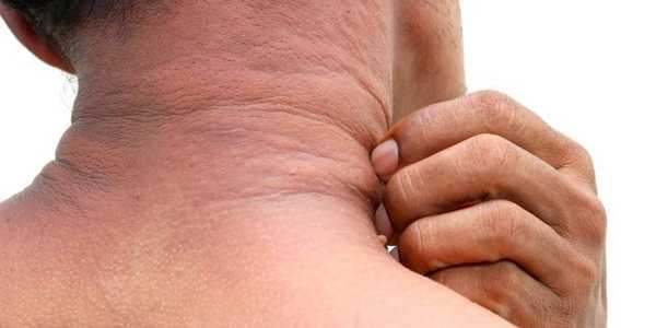 What HIV Symptoms Look Like in Men and Women